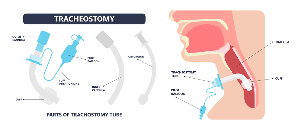 Tracheostomy Care Services